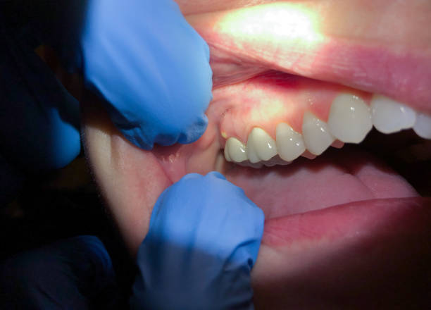 Best Emergency Wisdom Tooth Extraction in Malverne, NY